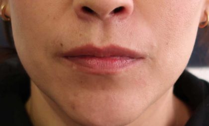 Lips Before & After Patient #8318