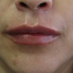 Lips Before & After Patient #8318