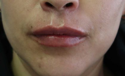 Lips Before & After Patient #8318