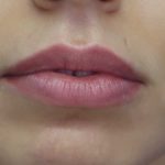 Lips Before & After Patient #8321