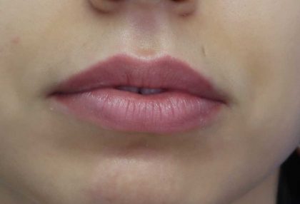 Lips Before & After Patient #8321