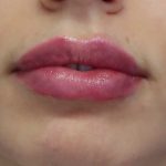 Lips Before & After Patient #8321