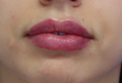Lips Before & After Patient #8321