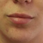 Lips Before & After Patient #8320