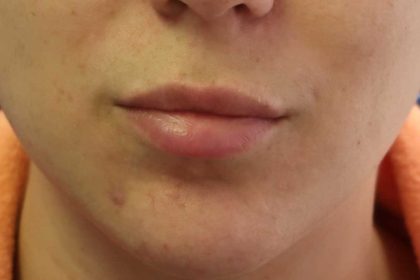 Lips Before & After Patient #8320