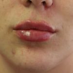 Lips Before & After Patient #8320