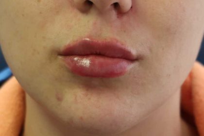 Lips Before & After Patient #8320