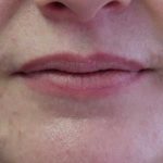 Lips Before & After Patient #8319