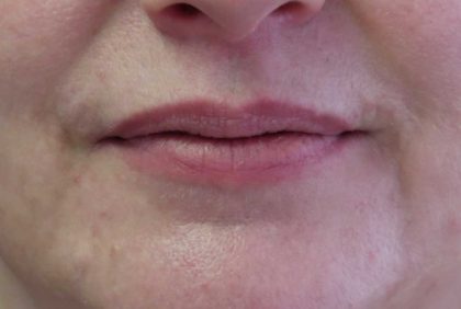 Lips Before & After Patient #8319