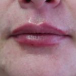 Lips Before & After Patient #8319