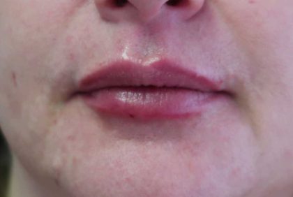 Lips Before & After Patient #8319