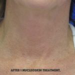 Renuvion Skin Resurfacing Before & After Patient #8375