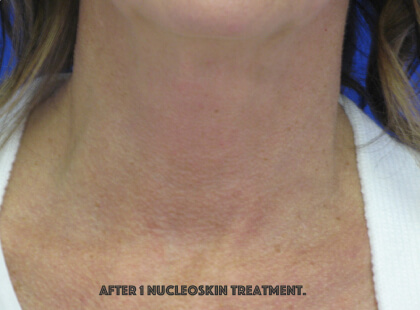 Renuvion Skin Resurfacing Before & After Patient #8375