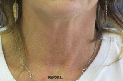 Renuvion Skin Resurfacing Before & After Patient #8375