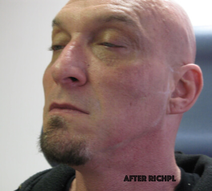 PRP (platelet-rich plasma) / PRF (platelet rich fibrin) Before & After Patient #8367