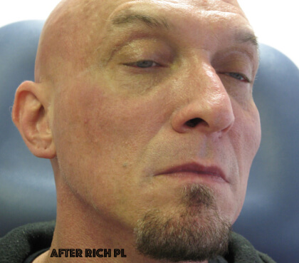 PRP (platelet-rich plasma) / PRF (platelet rich fibrin) Before & After Patient #8367