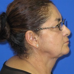 Renuvion Subcutaneous Skin Tightening Before & After Patient #8451