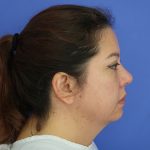 Renuvion Subcutaneous Skin Tightening Before & After Patient #8467