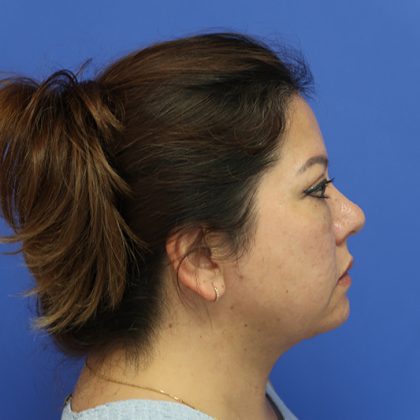 Renuvion Subcutaneous Skin Tightening Before & After Patient #8467