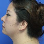Renuvion Subcutaneous Skin Tightening Before & After Patient #8467