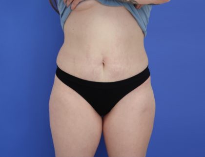 Liposuction Before & After Patient #8648