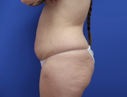 Liposuction Before & After Patient #8648