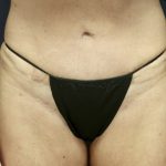 Monsplasty Before & After Patient #9010