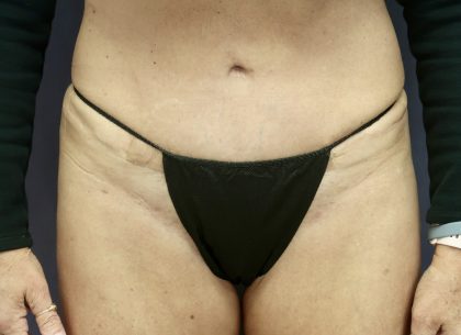 Monsplasty Before & After Patient #9010