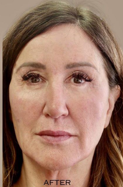 Global Volumization Before & After Patient #9024