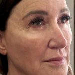 Global Volumization Before & After Patient #9024