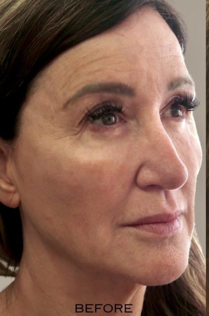 Global Volumization Before & After Patient #9024