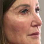 Global Volumization Before & After Patient #9024