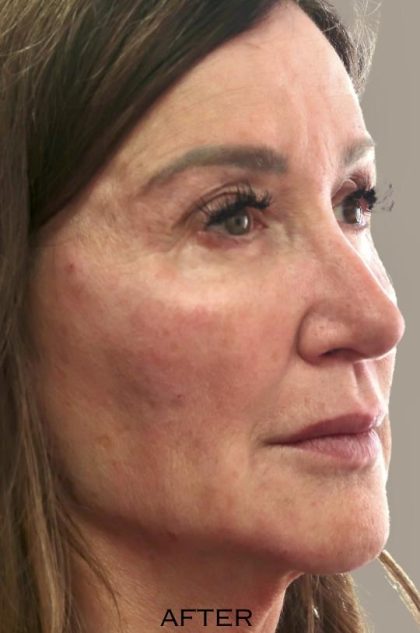 Global Volumization Before & After Patient #9024