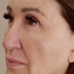 Global Volumization Before & After Patient #9024