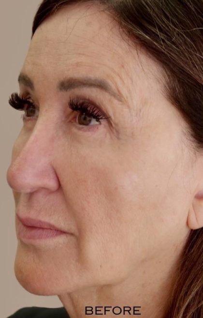 Global Volumization Before & After Patient #9024