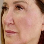 Global Volumization Before & After Patient #9024