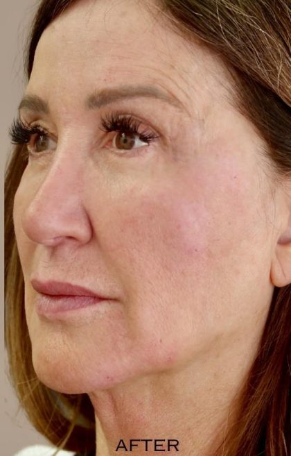 Global Volumization Before & After Patient #9024