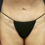 Vaginal Rejuvenation and Labiaplasty Before & After Patient #9056