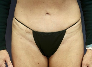 Vaginal Rejuvenation and Labiaplasty Before & After Patient #9056