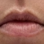 Lips Before & After Patient #9091