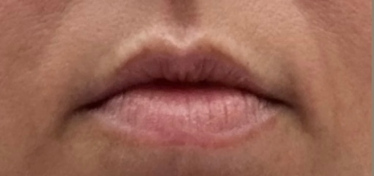 Lips Before & After Patient #9091