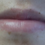 Lips Before & After Patient #9090