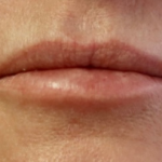 Lips Before & After Patient #9092
