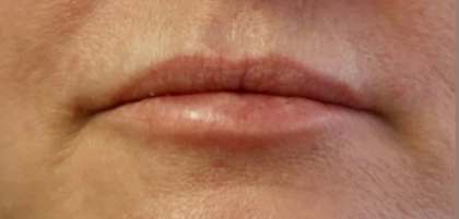 Lips Before & After Patient #9092