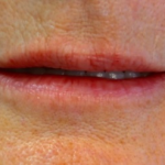 Lips Before & After Patient #9093