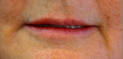 Lips Before & After Patient #9093