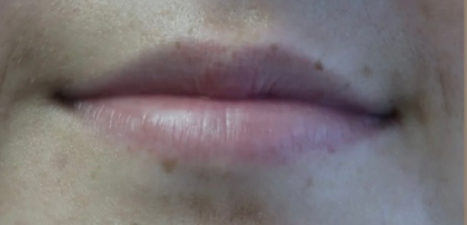 Lips Before & After Patient #9090