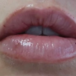 Lips Before & After Patient #9091