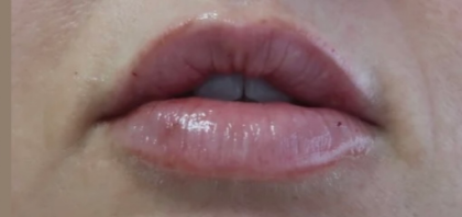 Lips Before & After Patient #9091