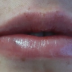 Lips Before & After Patient #9090